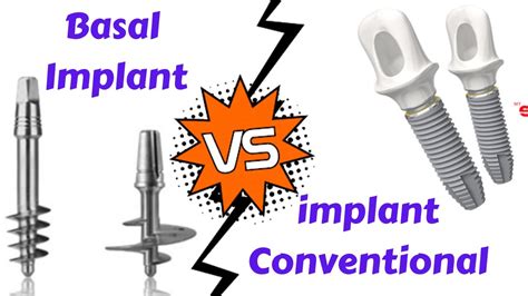 Basal Implant Vs Conventional Implant Advantage And Disadvantages