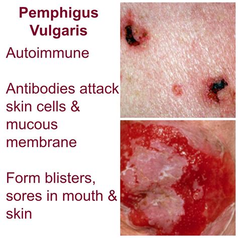 Life Threatening Skin Rash Series Pemphigus Vulgaris Eczema Blues