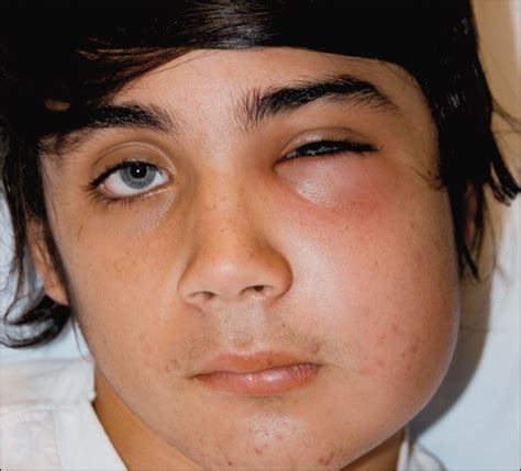 What Causes Swelling In The Face