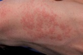 Heat rash (prickly heat) | nidirect