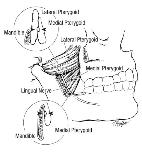 Lingual Nerve Injury During Suspension Microlaryngoscopy