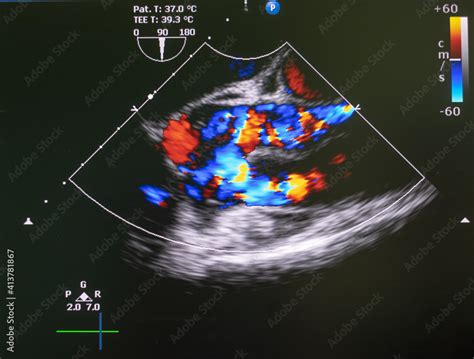 Echocardiography Ultrasound Machine Doppler Of Aortic Stenosis Stock