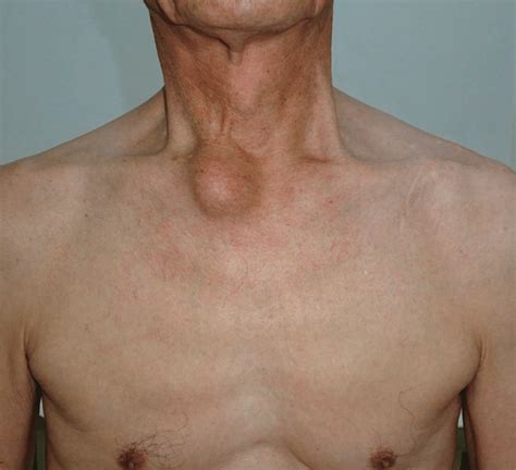 The Ganglion Cyst On Right Clavicle Near The Sternoclavicular Joint