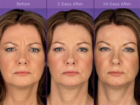 So how long does it take for botox to work, and how long does botox last for? Botox • Madsen Medical Spa