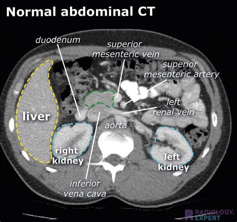 Normal Anatomy Radiologyexpert
