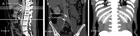 A The Vertebral Level Of The Celiac Trunk Upper L1 Sma Lower L1