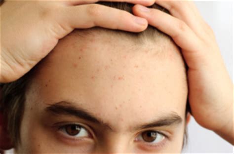 But that's not all to it, as they may not be a serious skin. How To Prevent Pimples Due To Dandruff - My Health Tips