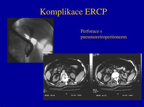 Ppt Ercp X Mrcp Powerpoint Presentation Free Download Id898145