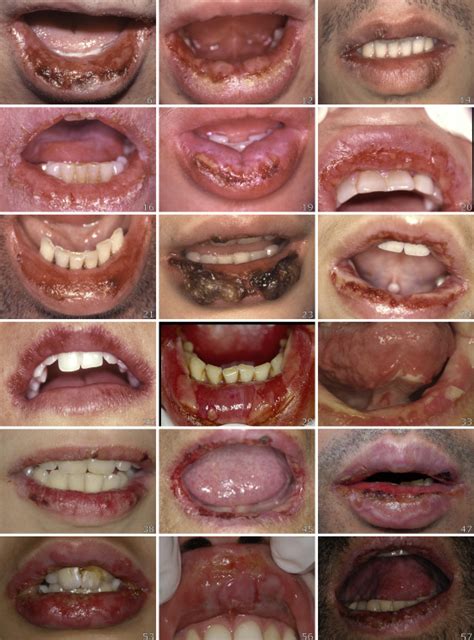 Oral Erythema Multiforme Trends And Clinical Findings Of A Large
