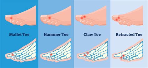 This Blog Deals With The Most Common Foot Condition Lesser Toe