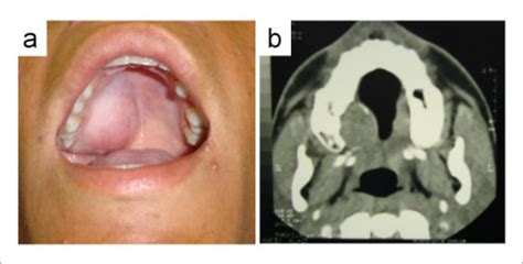 Figure 1plasmacytoid Myoepithelioma Of Minor Salivary Glands Report