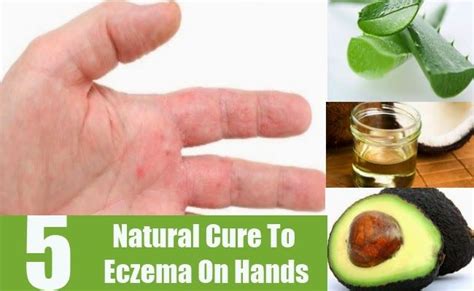 Home Remedies For Eczema On Hands ~ Home Remedies Eczema On Hands