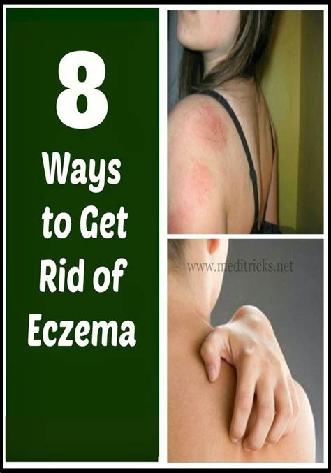 How To Get Rid Of Eczema Get Rid Of Eczema Eczema Remedies Home