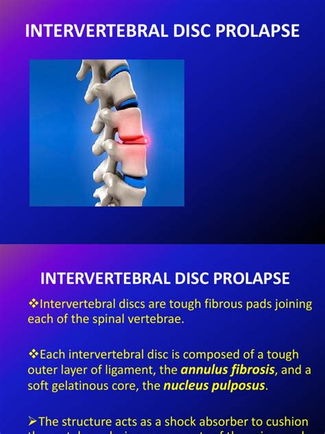 INTERVERTEBRAL DISC PROLAPSE Ppt Diseases And Disorders Clinical