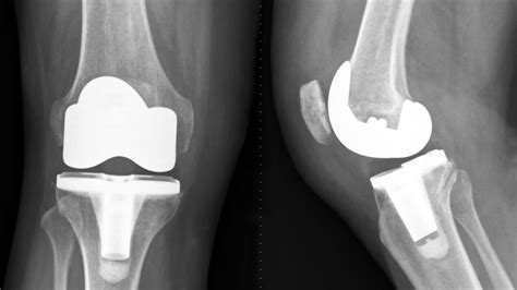 Total Knee Replacement Tkr Atau Dikenali Penggantian Sendi Lutut