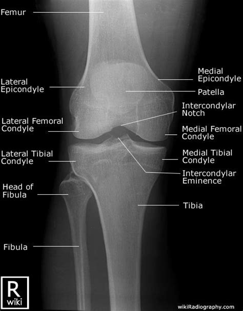 Radiographic Anatomy Knee Ap Radiology Student Medical Knowledge