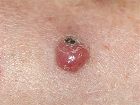 Merkel Cell Carcinoma The Skin Cancer Foundation