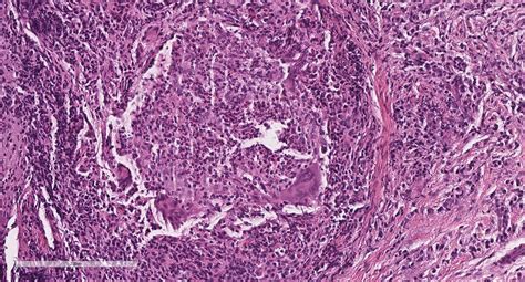 Pathology Outlines Chalazion