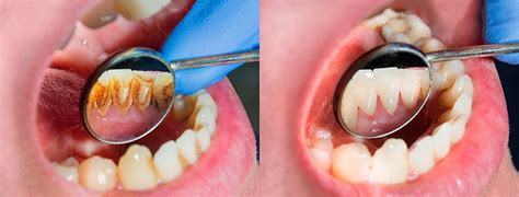 Los Beneficios De Una Limpieza Dental Profunda Cl Nica Dental Alberto