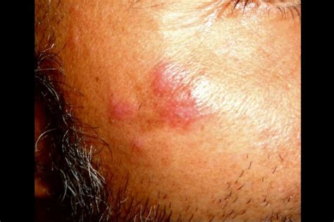 Dermdx Asymptomatic Rash On The Cheek And Forehead Dermatology Advisor