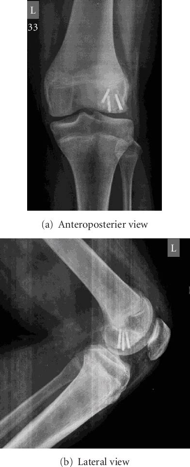 Figure From Osteochondral Fracture Lateral Femoral Condyle Treated With Orif Using Z Plasty A