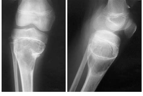 Radiographs Of The Right Knee With The Leg Showing A Multilocular Large