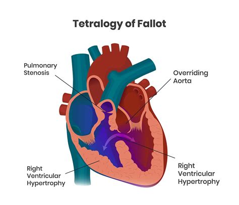 Congenital Heart Disease Tetralogy Of Fallot The Pulse