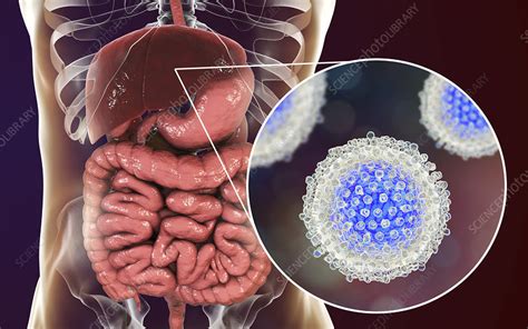 Hepatitis C Infection Illustration Stock Image F0222094 Science