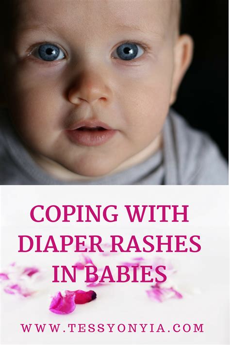 Is Your Baby Suffering From Diaper Rash Check Out How To Cope With It