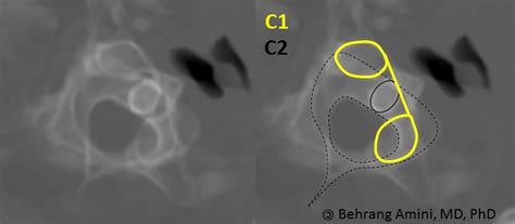 Roentgen Ray Reader Suspected Type I Rotatory Atlatoaxial Subluxation
