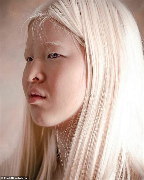 Albino Model Who Was Abandoned As A Baby In China Features In Vogue