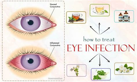 26 Effective Tips On How To Treat Eye Infection Naturally At Home