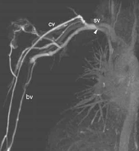 Maximum Intensity Projection Of A Ce Mr Angiogram Of Upper Extremity