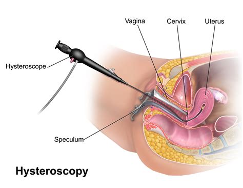 How long the symptoms last depends on the severity of the case. Hystéroscopie — Wikipédia