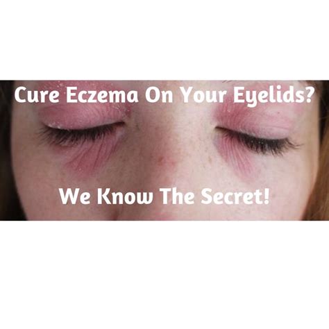 Eczema On Eyelids We Know A Secret Eczema On Eyelids Eczema