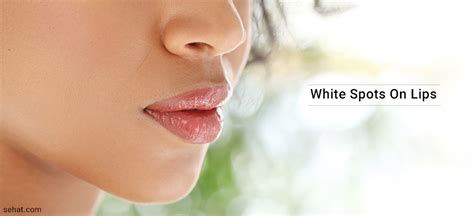 White Spots On Lips Causes