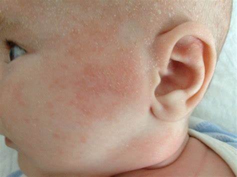 Аллергический дерматит какая диета Лечение атопического дерматита гомеопатией - Клиника С Ганемана Лечение атопического дерматита гомеопатией - Клиника С Ганемана Аллергический дерматит какая диета