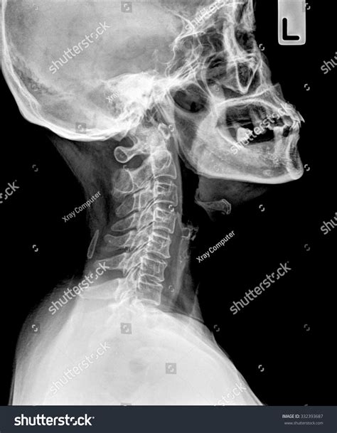 Xray Neck Cervical Spine Side View Stock Photo 332393687 Shutterstock