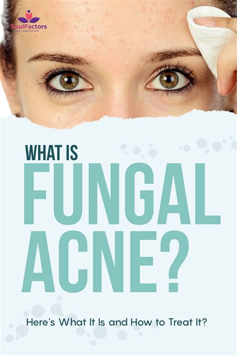 Fungal Acne Is Tricky To Diagnose And You Might Have It Acne