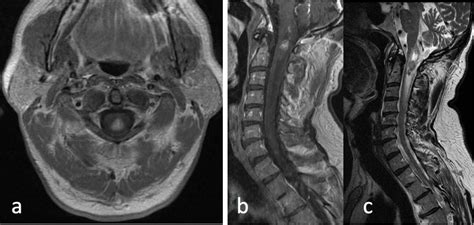 A Review Of Radiographic Imaging Findings Of Ependymal Tumors