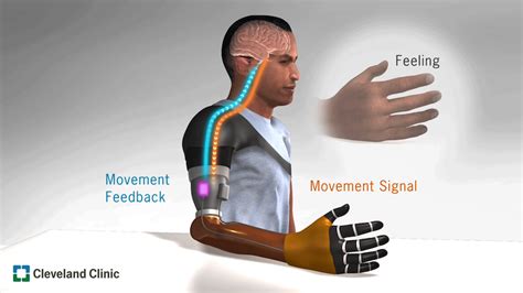 Cleveland Clinic Develops Bionic Arm That Restores ‘natural Behaviors