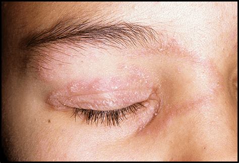 7 Causes And Effective Home Remedies To Get Rid Of Eyelid