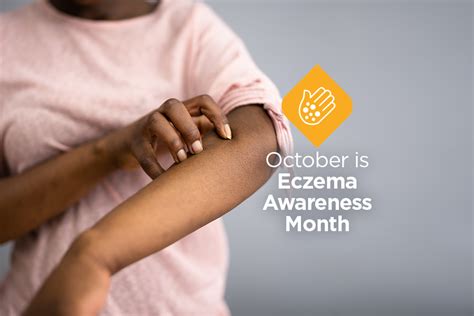 October Is National Eczema Awareness Month Here Are Some Facts You