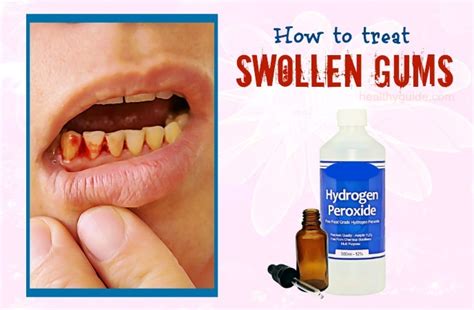 34 Tips How To Treat Swollen Gums Around Tooth And Cheek Fast