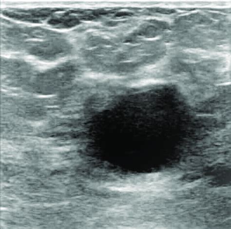 An Ultrasound Image Of Breast Cyst Download Scientific Diagram