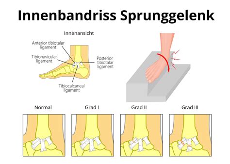 Zog sich beim fußball ein varustrauma zu. Innenbandriss am Sprunggelenk » Ursache, Symptome, Therapie