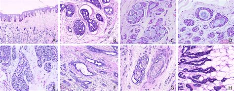 Frontiers Adenoid Cystic Carcinoma Of The Breast In A Male Patient A