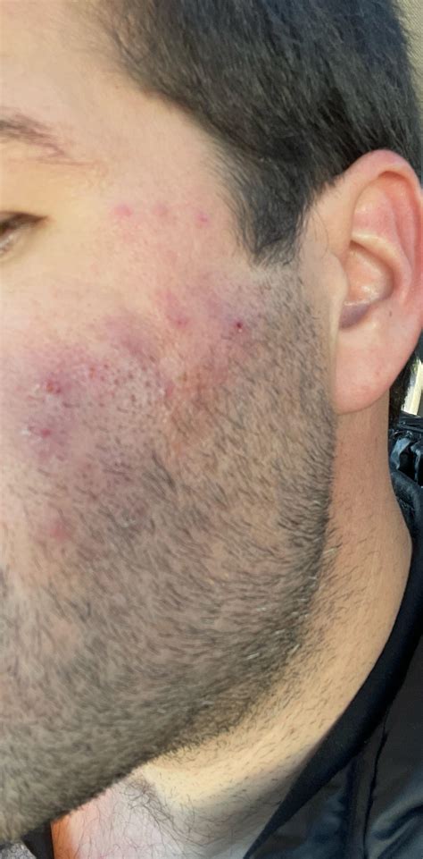 Skin Concern 36year Old Male Sick Of Cystic Acne Ruining All My