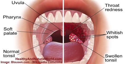 Causes Of White Spots On Throat Based On Science Images Included
