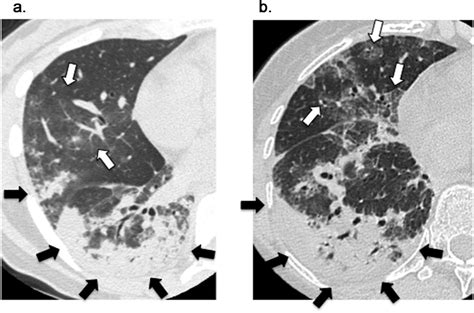 Airspace Consolidation A Thin Section Ct Scan Of The Right Lung In A